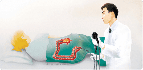 colonoscopy-img