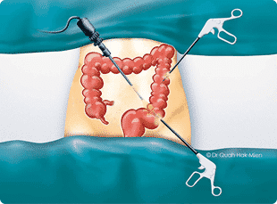 Appendix surgery, colon surgery